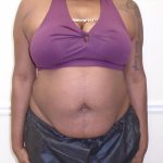 Lipo 360 Before & After Patient #998