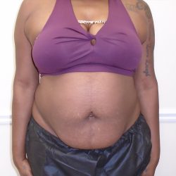 Lipo 360 Before & After Patient #998