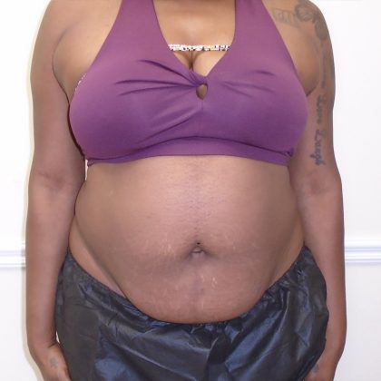 Lipo 360 Before & After Patient #998