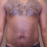 ULF Before & After Patient #1024
