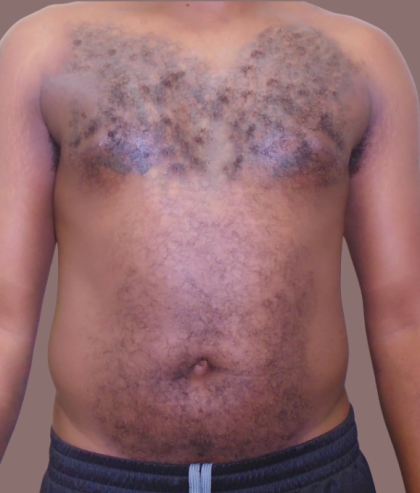 ULF Before & After Patient #1024