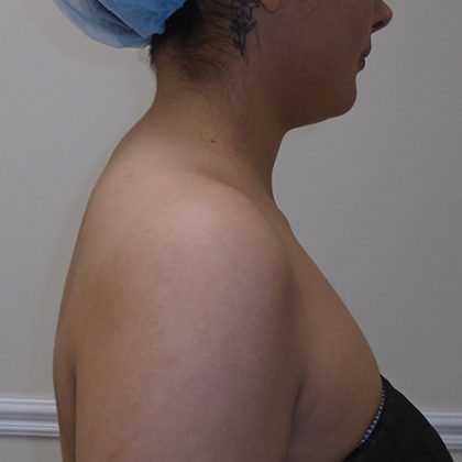 Buffalo Hump Liposuction Before & After Patient #993