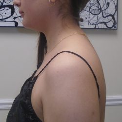 Buffalo Hump Liposuction Before & After Patient #993