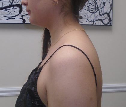 Buffalo Hump Liposuction Before & After Patient #993