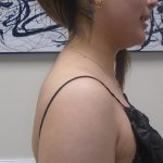 Buffalo Hump Liposuction Before & After Patient #993