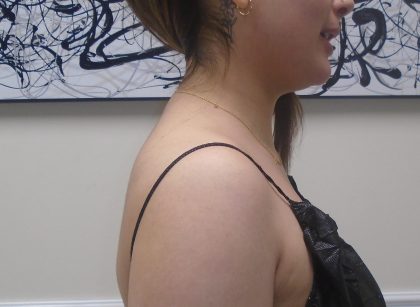 Buffalo Hump Liposuction Before & After Patient #993