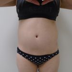 Lipo 360 Before & After Patient #1059