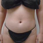 Lipo 360 Before & After Patient #1068