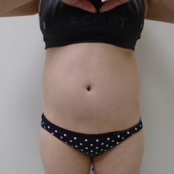 Lipo 360 Before & After Patient #1059