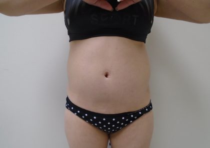 Lipo 360 Before & After Patient #1059