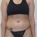 Lipo 360 Before & After Patient #1052