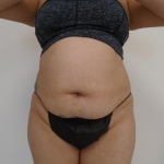 Lipo 360 Before & After Patient #1045