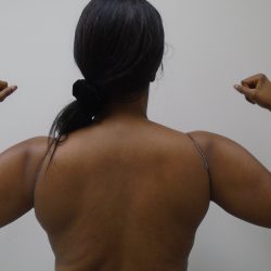 Arm Liposuction Before & After Patient #1075