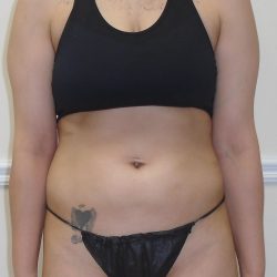 Lipo 360 Before & After Patient #1052