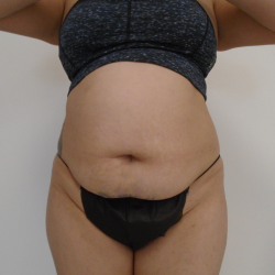 Lipo 360 Before & After Patient #1045
