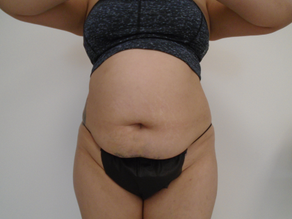 Lipo 360 Before & After Patient #1045