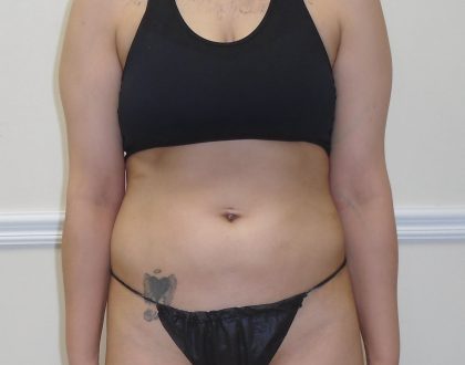 Lipo 360 Before & After Patient #1052