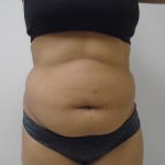 Lipo 360 Before & After Patient #1090