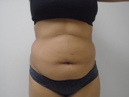 Lipo 360 Before & After Patient #1090