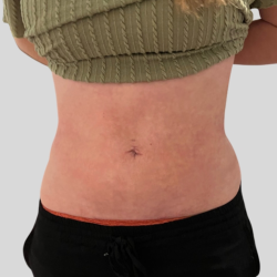 Lipo 360 Before & After Patient #1068
