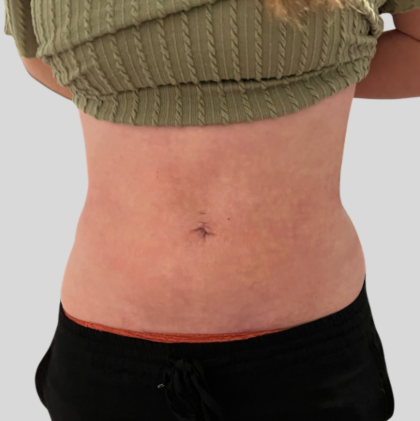 Lipo 360 Before & After Patient #1068