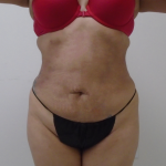 Lipo 360 Before & After Patient #1045
