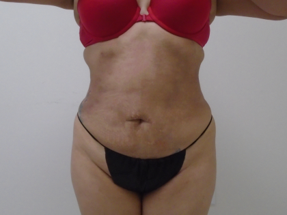 Lipo 360 Before & After Patient #1045