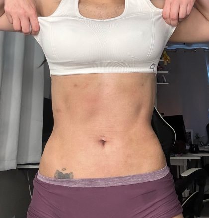 Lipo 360 Before & After Patient #1052