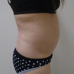 Lipo 360 Before & After Patient #1059