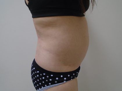 Lipo 360 Before & After Patient #1059