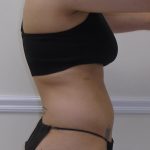Lipo 360 Before & After Patient #1052