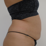 Lipo 360 Before & After Patient #1045