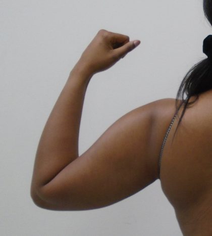 Arm Liposuction Before & After Patient #1075