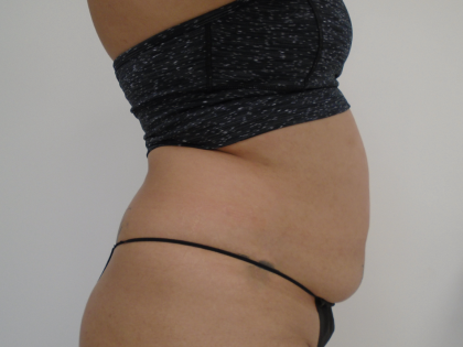 Lipo 360 Before & After Patient #1045