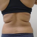 Lipo 360 Before & After Patient #1090