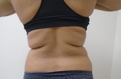 Lipo 360 Before & After Patient #1090