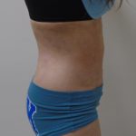 Lipo 360 Before & After Patient #1059