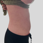 Lipo 360 Before & After Patient #1068