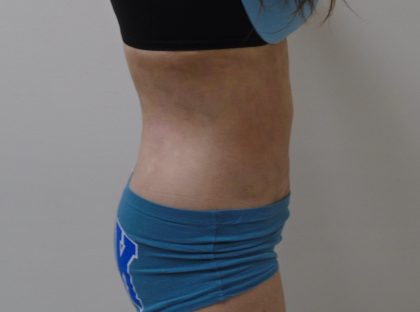 Lipo 360 Before & After Patient #1059
