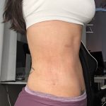 Lipo 360 Before & After Patient #1052