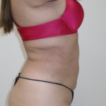 Lipo 360 Before & After Patient #1045