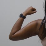 Arm Liposuction Before & After Patient #1075
