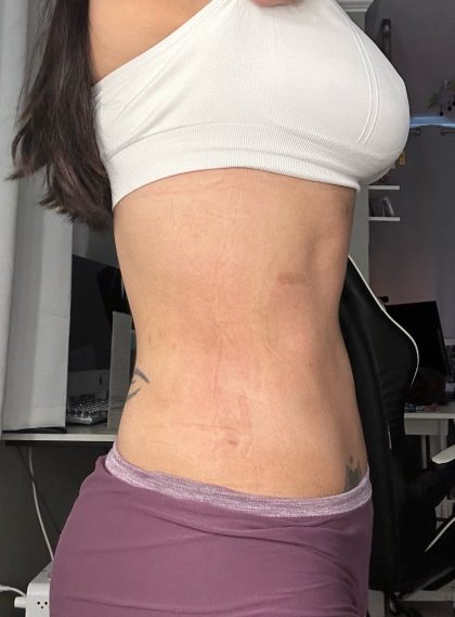 Lipo 360 Before & After Patient #1052