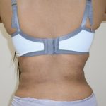 Lipo 360 Before & After Patient #1090