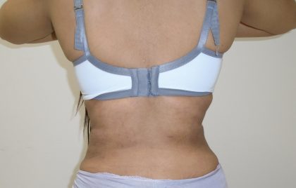 Lipo 360 Before & After Patient #1090