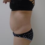 Lipo 360 Before & After Patient #1059
