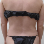 Lipo 360 Before & After Patient #1068