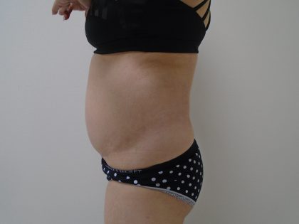 Lipo 360 Before & After Patient #1059