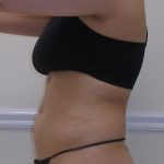 Lipo 360 Before & After Patient #1052