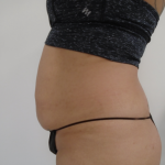 Lipo 360 Before & After Patient #1045